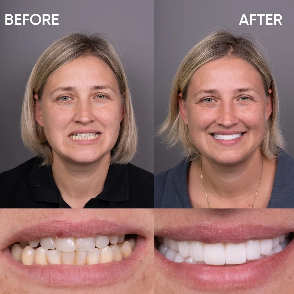 Smile makeover before and after results Turkey