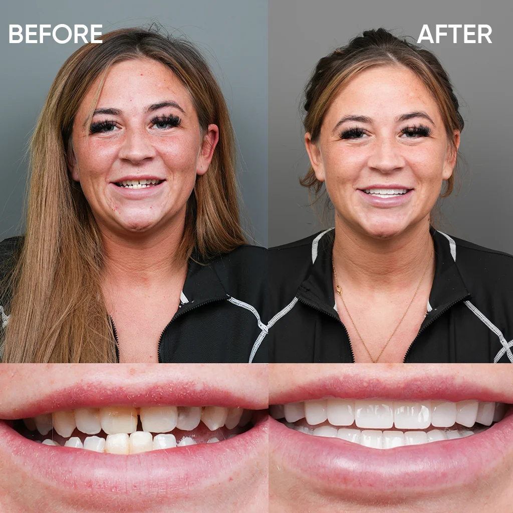 Smile makeover before and after results Turkey