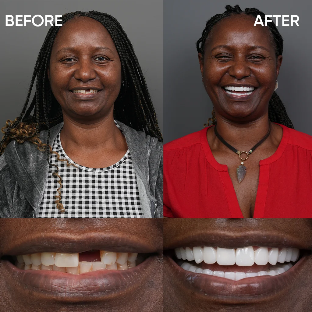 Smile makeover before and after results Turkey