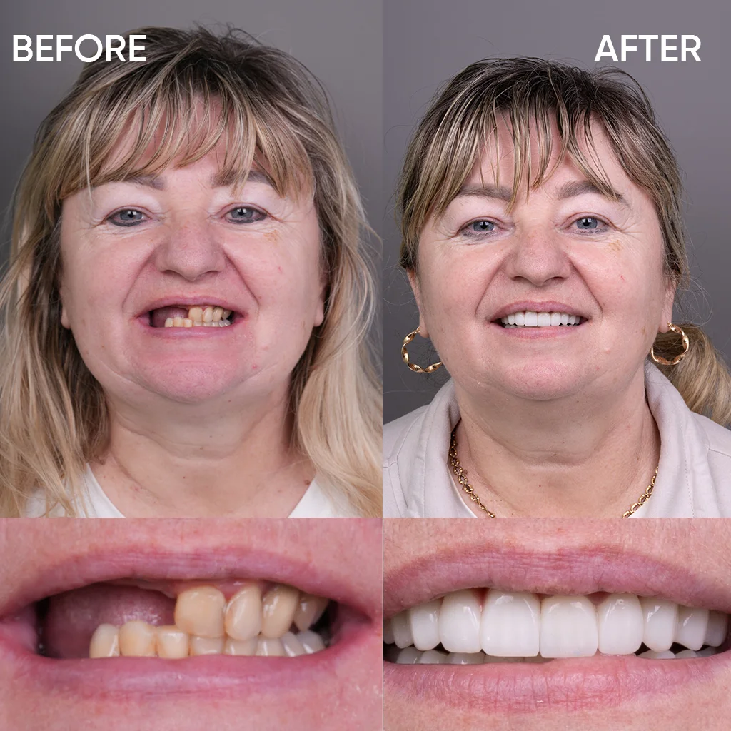 Smile makeover before and after results Turkey